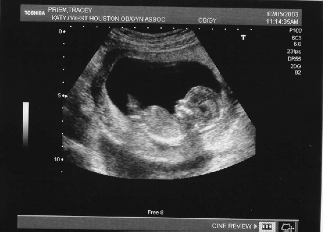 our second ultrasound shows an