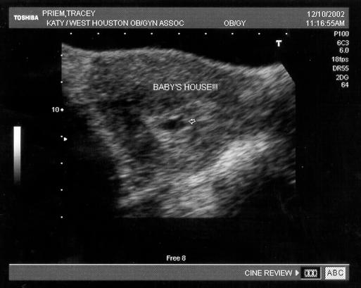 sonogram 5 weeks. Dec 10 (5 weeks)